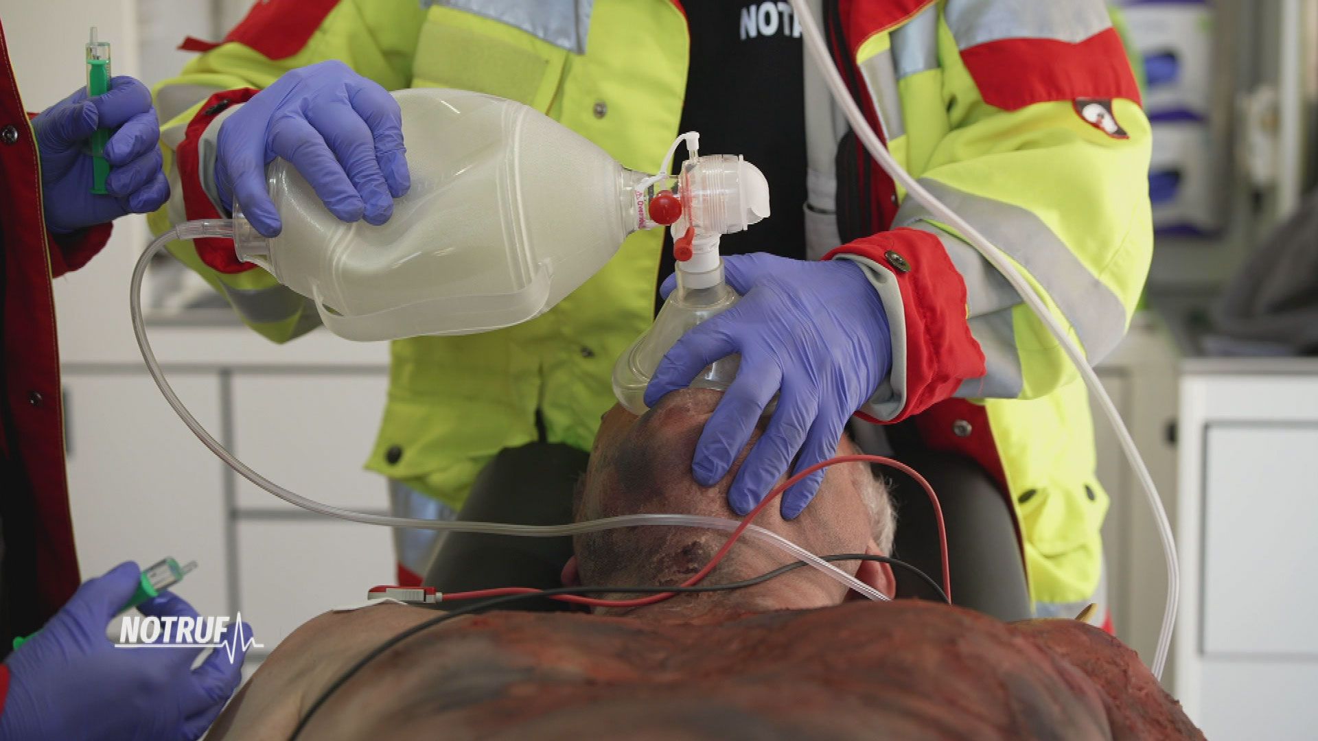 Schwere Verbrennung nach Kerzenunfall