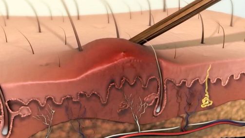 Treffpunkt Medizin Treffpunkt Medizin Folge 50: treffpunkt medizin: Warnsignale des Körpers: Entzündungen