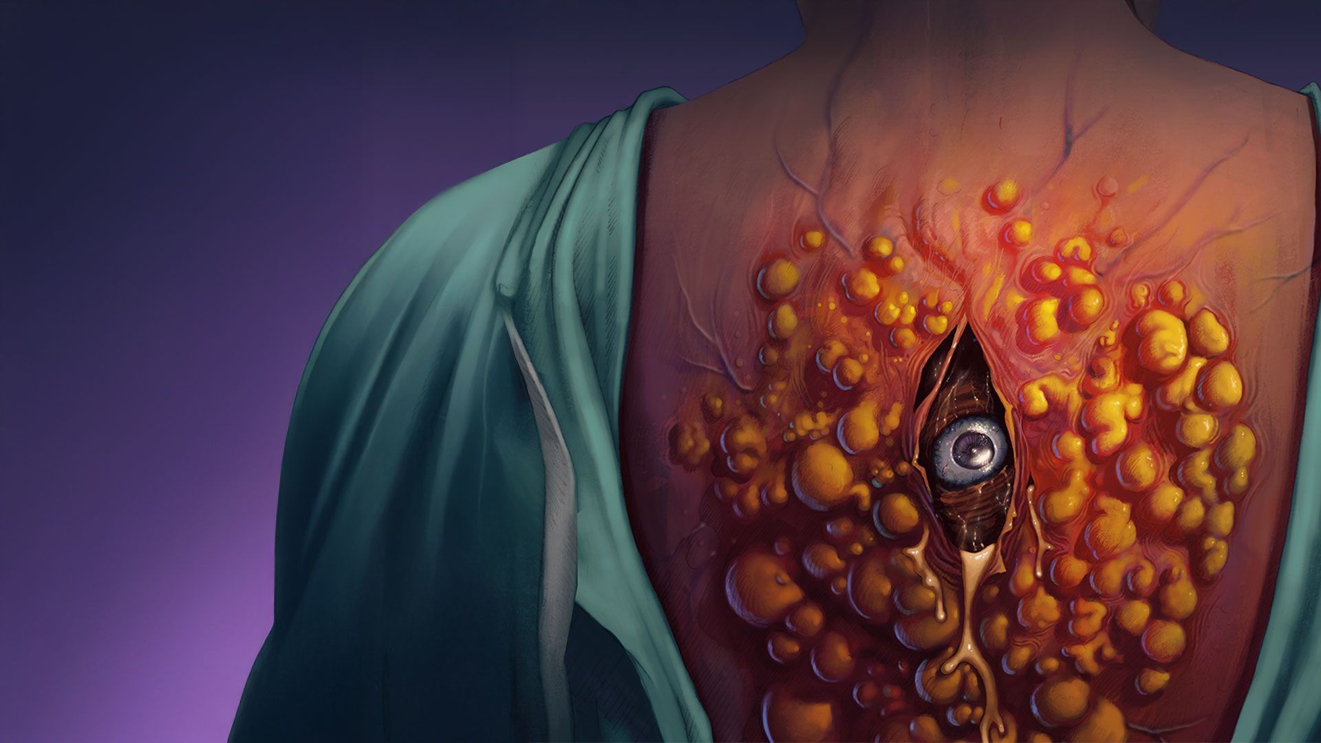 Cyst