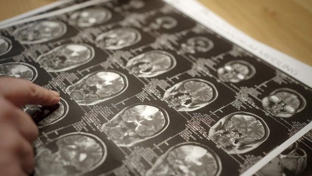 Der Feind in meinem Kopf: Kampf gegen Hirntumore