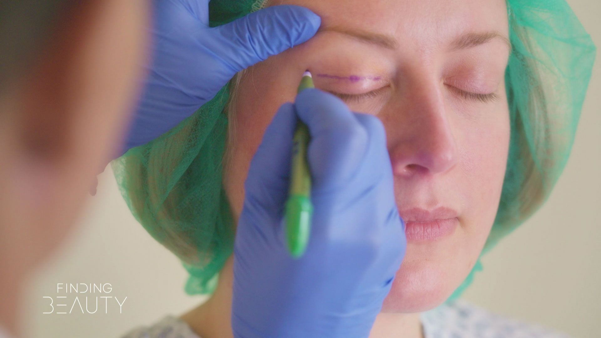 Oberlidstraffung: Mit Fachexpertise zum natürlichen Look