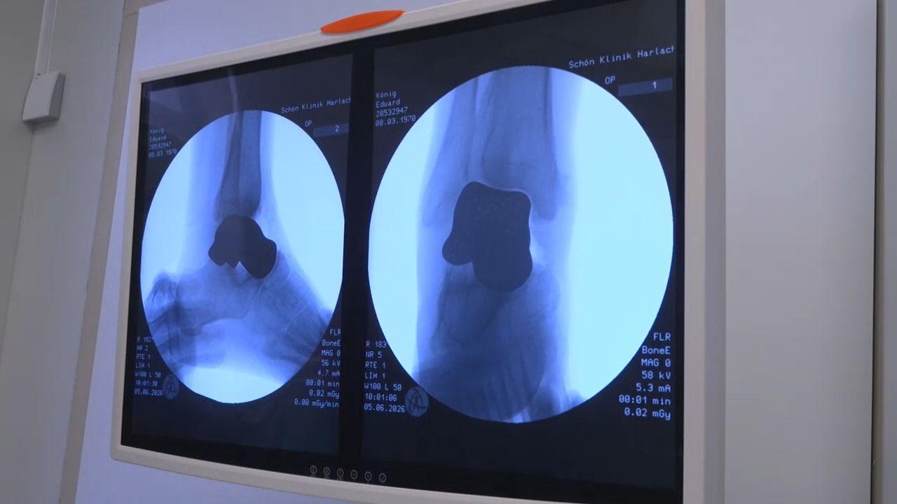 Knochen aus dem 3D-Drucker: Hoffnung für Sprunggelenk-Patienten
