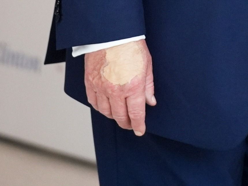 Ist Donald Trump krank? Ein auffälliger Fleck auf seiner Hand wirft Fragen auf